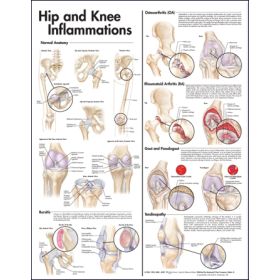 Hip & Knee Inflammations 2E, 20 X 26