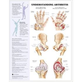 Understanding Arthritis, Laminated